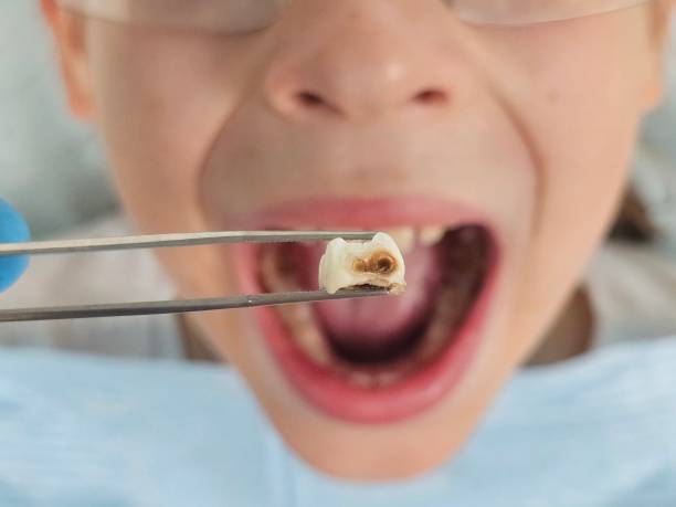 Best Emergency Broken Tooth Repair in Argos, IN